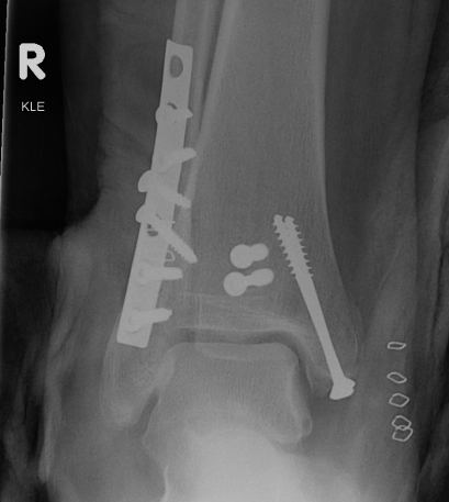 Ankle Fracture Trimalleolar ORIF